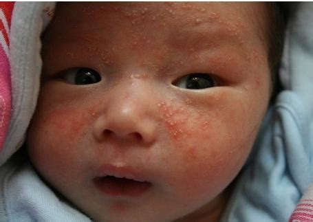 8个月婴儿吃海苔粉过敏