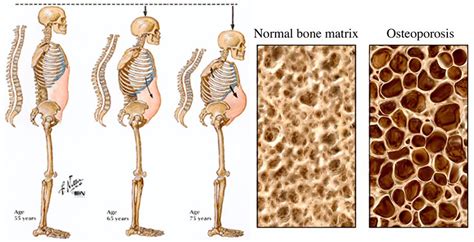 osteoporoses啥意思